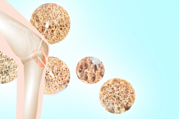 Osteoporosis - Gejala, penyebab dan mengobati